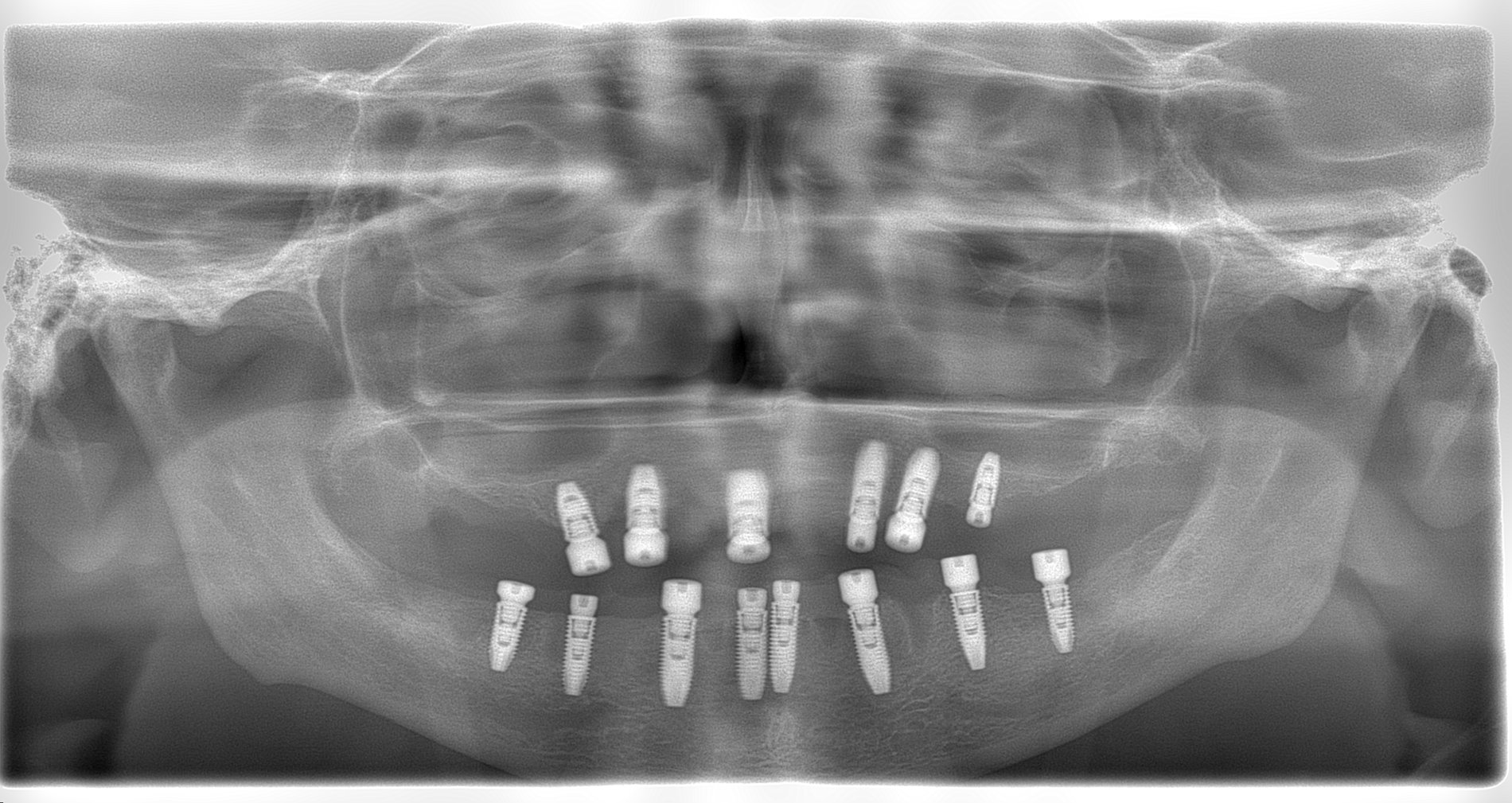 снимок после имплантации в Europe Dental